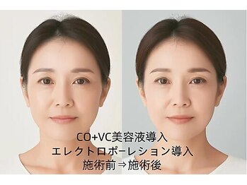 憩いサロンユリ 蕨店(Yuri)/エレクトロポーレション導入