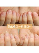 マニエネイル(mani e nail)/深爪矯正の14日目はこんな感じ
