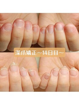 マニエネイル(mani e nail)/深爪矯正の14日目はこんな感じ