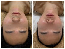 ヨジャラボ(ヨジャLAB)/チタニウムリフト＋LDM