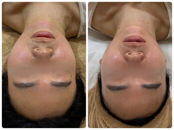 ヨジャラボ(ヨジャLAB)/チタニウムリフト+LDM