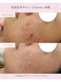 シャルム(Charme)&nbsp;ハーブピーリング