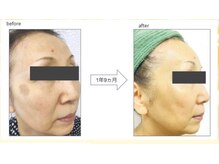 ビューティスタジオＫ/シミが消えたフェイシャル