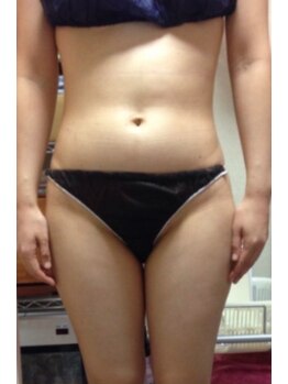 スキンケアスタジオ アコ 新宿店(Aco)/キャビテーション90分１回2/痩身