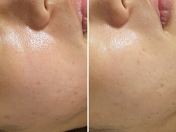 おうちサロン ミキ/イオン導入で透明感&浸透力UP