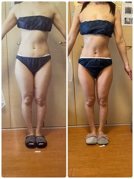 カラーリリー(calla lily)/キャビテーション痩身/痩身/小顔