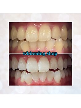 ホワイトニングショップ 奈良香芝店(Whitening shop)/ホワイトニング効果実感☆