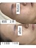 【最強★たるみケア】EMS&エアバリ＆乳歯幹細胞導入（歯髄100%）