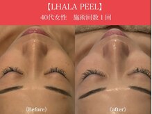 リプロ(RePro)/ララピール　ビフォーアフター