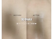 ルナソルビューティーサロン 浜松店(Lunasol)/背中 MIX脱毛♪