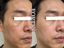 フォーティープラス(FORTY+)/施術事例