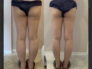 ヨヌア(yonua)の写真/夏本番はすぐそこ！気になるコンプレックス解消！理想の美脚で魅せる準備を始めよう♪