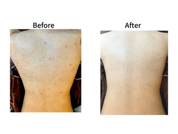 サロンドシュシュ 心斎橋本店(salon de chouchou)/REVI背中剥けないハ-ブピ-リング