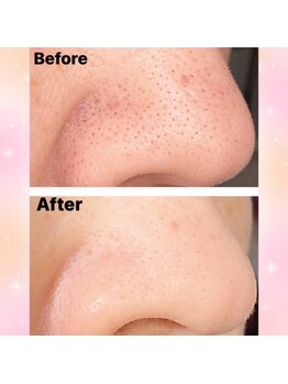 ルアナ(Luana)/鼻頭の角栓除去ビフォーアフター