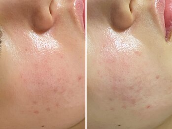 おうちサロン ミキ/肌質改善の漢方ハーブピーリング