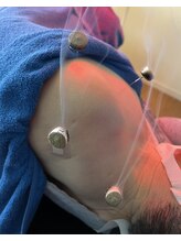 そるーな鍼灸院整体院/お灸施術で関節の痛み改善