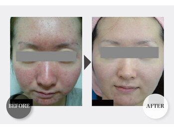 GRACETHOUSAND(グレイスサウザンド)/ハーブピーリング/くすみ/赤ら顔