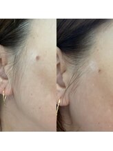 サロン ド ルミナ(salon de lumina)/シミケア