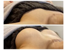 モナンジュ(ramonange)/バストアップbefore after