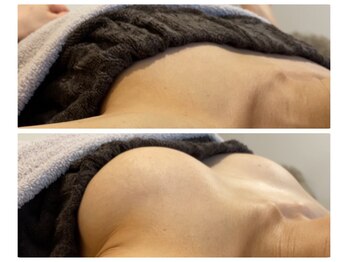 モナンジュ(ramonange)/バストアップbefore after