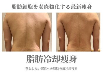 エクラ イオンモール徳島店(ECLAT)/脂肪冷却痩身