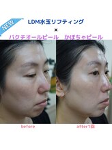アップルミント/＜フェイシャル＞before・after