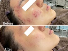 ニキビケア研究所 本厚木店/頬からフェイスラインニキビケア