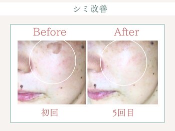 トータルビューティー ゆみえエステ(Total Beauty)/光フォト(光フェイシャル)