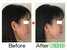 小顔矯正エステ プリュムレーヴ/40代｜面長印象がすっきり