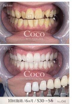 ココホワイトニング 天王寺店/ビフォーアフター2
