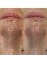 アルメ(arme)/【毛穴】