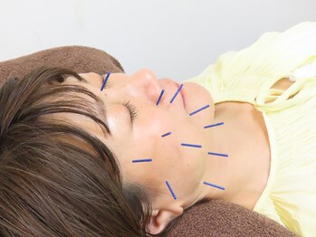 マッチ鍼灸整骨院/美容鍼灸でうるおい肌