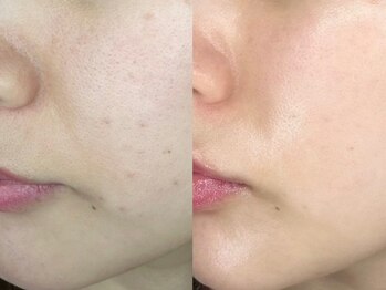 ロイ 初生店(LOI)/乾燥肌に水分補給！アンストレス