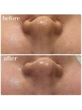 プライベートサロン ラ ペーシュ/黒ずみに♪韓国式３D毛穴洗浄