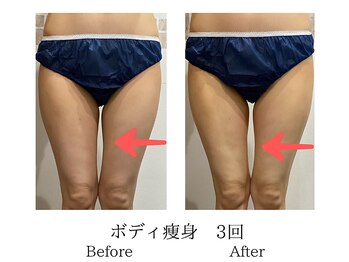 ミーシェ(Meshie)/ボディ痩身！足の隙間に注目！