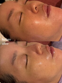 ルミナス(Luminous)/ララピールbefore→after