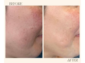 レヴ 都城店(rev)/お肌の赤みに