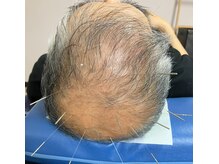 泰然/頭皮に鍼で対策していきます