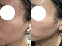 フル(FUL)/フェイシャルスタンダードケア