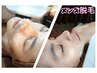 【メンズ】ヒゲ全体脱毛6000円