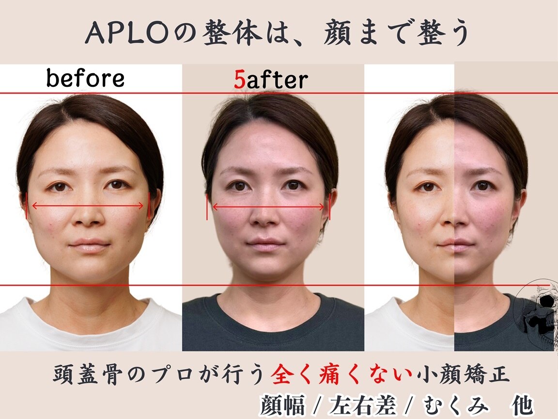 中顔面を短くする 両顎骨切り」 すでに綺麗なお顔をされています