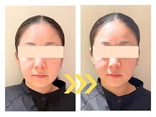 ビハリスト 恵比寿/1回でほうれい線が改善！