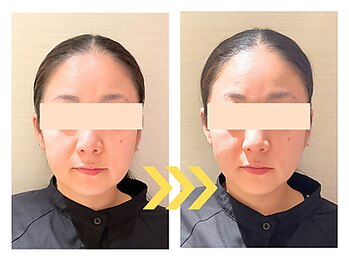 ビハリスト 恵比寿/1回でほうれい線が改善!