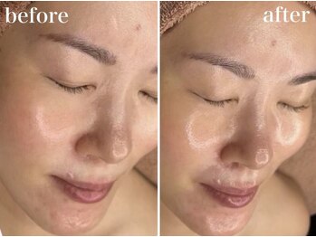 ホワイトアクア 京橋店(WHITE AQUA)/ララピール/ニキビケア