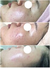 エヌエー(na)/肌質改善・ぷつぷつニキビケア