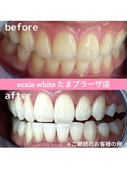 エクシアホワイトニング たまプラーザ店/ビフォーアフター