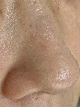 ルアンエステティック(RUAN esthetic)の写真/【今から本格毛穴ケア☆￥7,150】毛穴開き・たるみ・小鼻の黒ずみを改善！毛穴レスな美肌のお手伝い♪