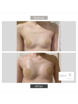 シーボウ(CBOU)/脂肪増殖　10ml(バストアップ)