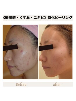 カナウ produced by きょうわ整体院(Kanau.)/《透明感・くすみ・ニキビ》