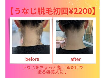 シルクスタンダード(SILK STANDARD)/うなじ脱毛